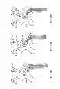 Fig. 16 - Variable length catheter for drug delivery