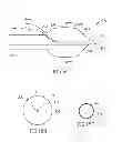 Fig. 23 - Variable length catheter for drug delivery
