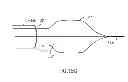 Fig. 25 - Variable length catheter for drug delivery
