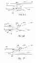 Fig. 32 - Variable length catheter for drug delivery
