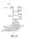 Fig. 22 - Lacrimal implants and related methods