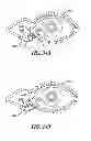 Fig. 23 - Lacrimal implants and related methods