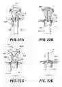 Fig. 35 - Apparatus for treating a portion of a reproductive system and related methods of use