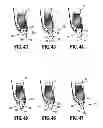 Fig. 25 - Pediatric combination surgical device