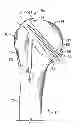 Fig. 01 - Patient-specific cutting guide for the shoulder