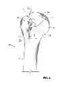 Fig. 04 - Patient-specific cutting guide for the shoulder