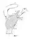 Fig. 07 - Patient-specific cutting guide for the shoulder