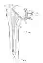 Fig. 09 - Patient-specific cutting guide for the shoulder