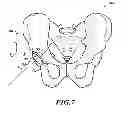 Fig. 08 - Devices and methods for hip replacement