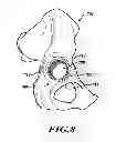 Fig. 09 - Devices and methods for hip replacement