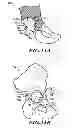 Fig. 12 - Devices and methods for hip replacement