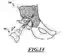 Fig. 13 - Devices and methods for hip replacement