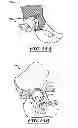 Fig. 14 - Devices and methods for hip replacement