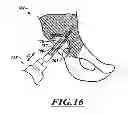 Fig. 15 - Devices and methods for hip replacement