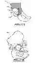 Fig. 16 - Devices and methods for hip replacement