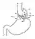 Fig. 01 - TRANSESOPHAGEAL GASTRIC REDUCTION METHOD AND DEVICE FOR REDUCING THE SIZE OF A PREVIOUSLY FORMED GASTRIC REDUCTION POUCH