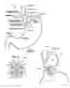 Fig. 02 - TRANSESOPHAGEAL GASTRIC REDUCTION METHOD AND DEVICE FOR REDUCING THE SIZE OF A PREVIOUSLY FORMED GASTRIC REDUCTION POUCH