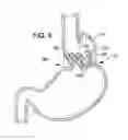 Fig. 04 - TRANSESOPHAGEAL GASTRIC REDUCTION METHOD AND DEVICE FOR REDUCING THE SIZE OF A PREVIOUSLY FORMED GASTRIC REDUCTION POUCH