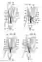 Fig. 09 - TRANSESOPHAGEAL GASTRIC REDUCTION METHOD AND DEVICE FOR REDUCING THE SIZE OF A PREVIOUSLY FORMED GASTRIC REDUCTION POUCH