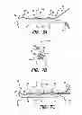 Fig. 08 - Insertion tool for paddle-style electrode
