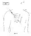 Fig. 02 - IMPLANTABLE MEDICAL DEVICE FIXATION