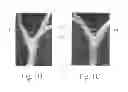 Fig. 03 - ELECTROSTIMULATION IN TREATING CEREBROVASCULAR CONDITIONS