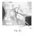 Fig. 16 - ELECTROSTIMULATION IN TREATING CEREBROVASCULAR CONDITIONS
