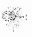 Fig. 03 - DISCECTOMY DEVICES AND METHODS