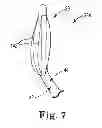 Fig. 07 - Sinus dilation system and method