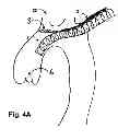 Fig. 06 - Method for delivery of an embolic protection unit