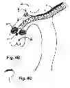 Fig. 07 - Method for delivery of an embolic protection unit