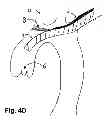 Fig. 08 - Method for delivery of an embolic protection unit