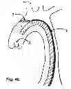 Fig. 09 - Method for delivery of an embolic protection unit