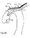 Fig. 11 - Method for delivery of an embolic protection unit
