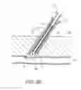 Fig. 12 - Apparatus and methods for sealing a vascular puncture