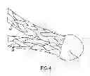 Fig. 05 - System for securing sutures