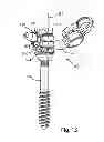 Fig. 16 - System and Method for Bone Anchorage