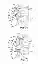 Fig. 12 - Dynamic fixation device and method of use