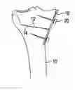 Fig. 01 - Methods and systems for planning and performing an osteotomy