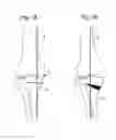Fig. 02 - Methods and systems for planning and performing an osteotomy