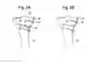 Fig. 03 - Methods and systems for planning and performing an osteotomy