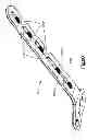 Fig. 33 - Highly-versatile variable-angle bone plate system