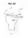 Fig. 05 - Polyaxial bone screw