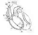 Fig. 01 - Cardiac stimulating device