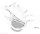 Fig. 12 - Methods and systems for lowering blood pressure through reduction of ventricle filling