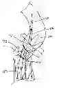Fig. 01 - Expandable stent-graft system having diameter reducing connectors