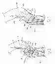 Fig. 06 - Expandable stent-graft system having diameter reducing connectors