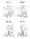 Fig. 09 - Cannulation guiding device for bifurcated stent and method of use