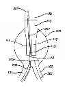 Fig. 01 - STENT CANNULATION GUIDING DEVICE AND METHOD OF USE