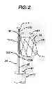 Fig. 03 - STENT CANNULATION GUIDING DEVICE AND METHOD OF USE